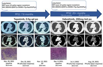 Frontiers Case Report The Effect Of Second Line Vebreltinib